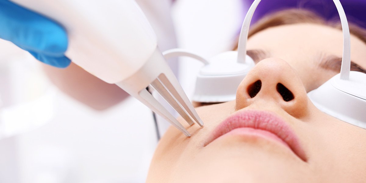 Laser brightening treatment