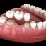 dental crowns sutherland shire