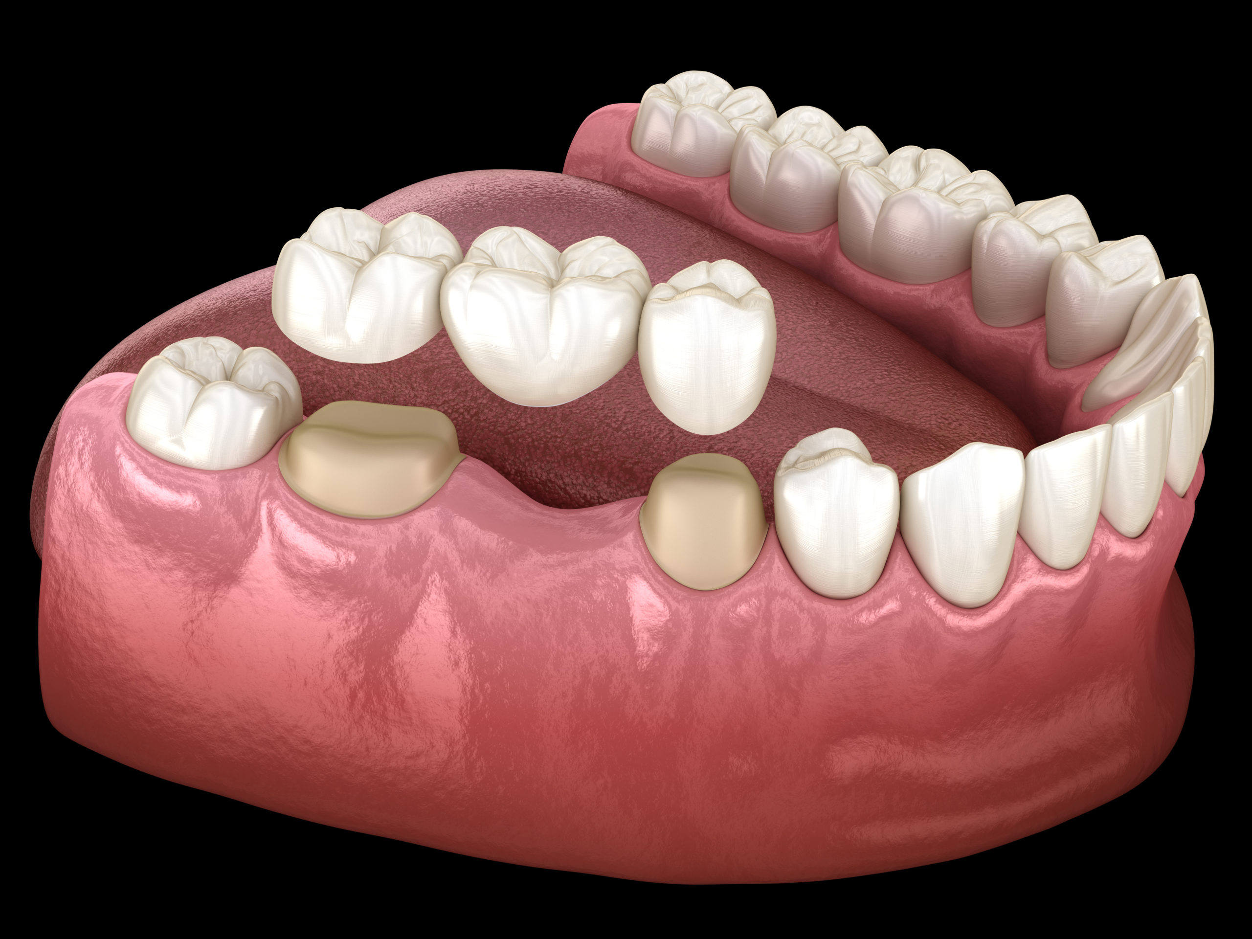 dental crowns sutherland shire