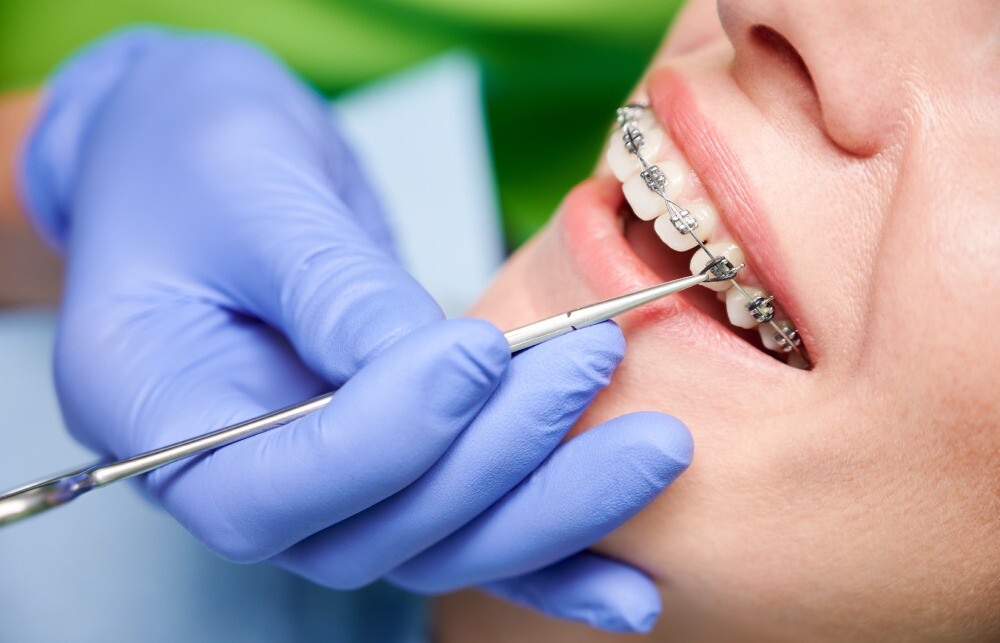 Guildford Orthodontics: A Guide To Straightening Teeth